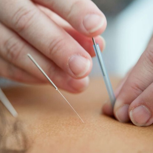 Person getting acupuncture