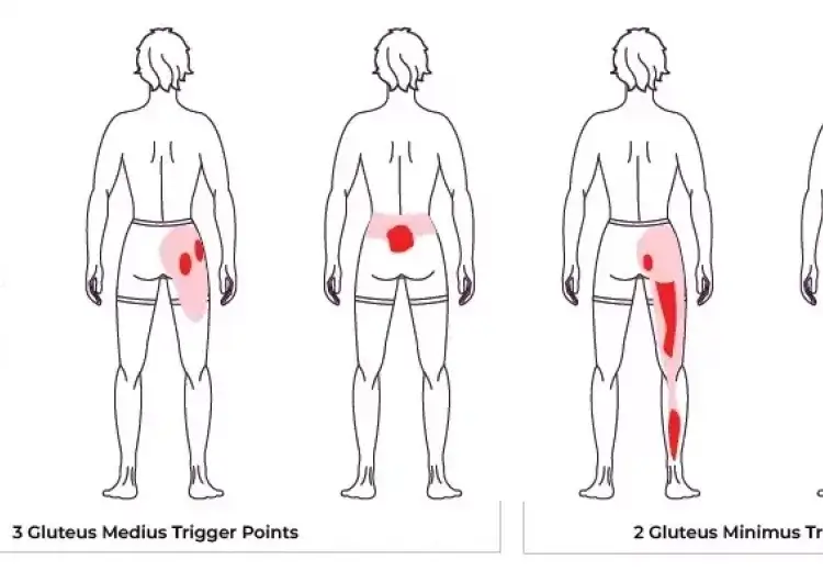 sciatica-pain-trigger-point-diagram-1 (1)